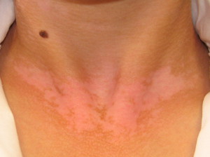 Napallergia, napkiütés, napgomba, fényérzékenység, vitiligo, lentigo, keratózis, melasza - és más bőrbetegségek tünetei