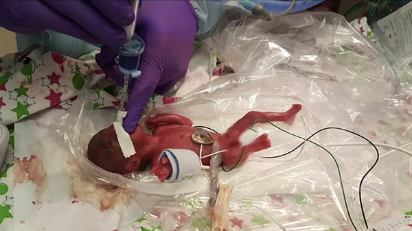 Hazaengedték a kórházból a világ legkisebb újszülött babáját! - 245 grammal született, nem hitték, hogy életben marad