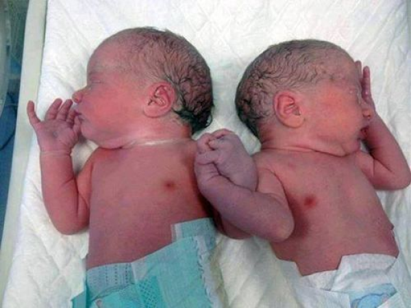 Születésük után rögtön megfogták egymás kezét az ikerbabák