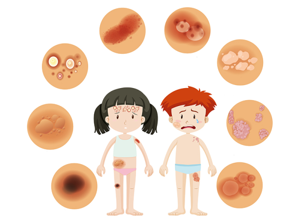 Bőrbetegségek tünetei: Napallergia, napkiütés, napgomba, fényérzékenység, vitiligo, lentigo, keratózis, melasza és más