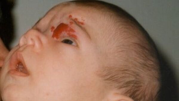 Veszélyes is lehet a tűzfolt, bőrelváltozás, dudor a kisbaba bőrén? Sebész szakorvost kérdeztünk