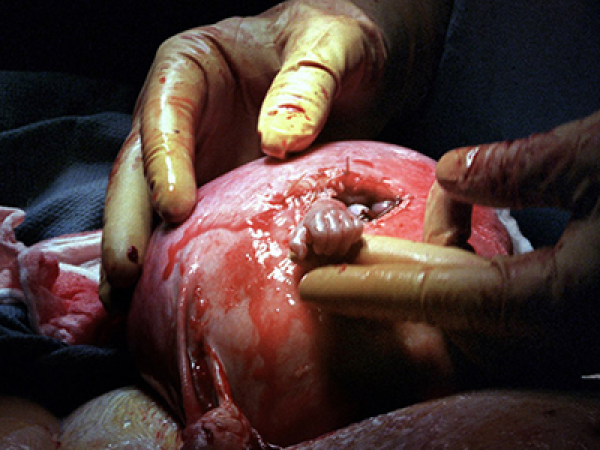 Emlékszel a fotóra, amin egy kis kéz kinyúlt az anyaméhből műtét közben és megfogta az orvos ujját? Már 16 éves az a fiú!