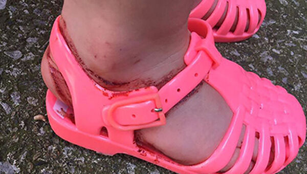 Ezért nem mindegy, milyen cipőt veszel a gyereknek! Nézd meg, milyen sérülést okozott egy műanyag szandál 