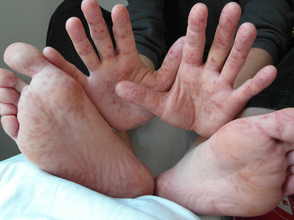 Kéz-láb-száj betegség okai, tünetei, kezelése: Fájdalmas vírus, ami főként gyerekek között terjed