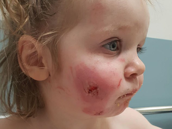 Brutálisan megharaptak egy 17 hónapos kislányt a játszóházban! - 15 harapásnyomot számoltak rajta össze a kórházban