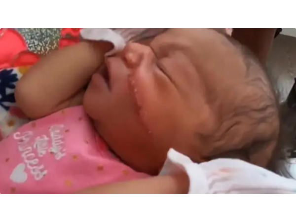 Csúnya vágási seb maradt egy kisbaba arcán a császármetszés után - 13 öltéssel varrták össze