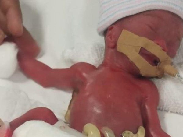 A világ legkisebb újszülöttje: Életben maradt a 25. hétre, 212 grammal született kislány! - Nem sok esély volt a túlélésére